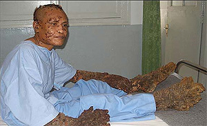 the tree man dede