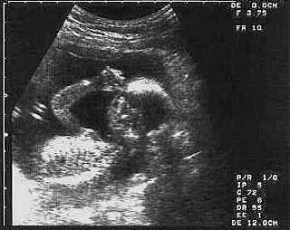ultrasound picture of baby fetus 120509