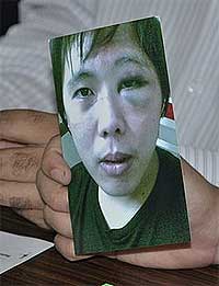 koh chon weng police brutality victim black eye 070609 02