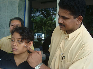 three indonesian maid abused ipoh 030609 black eye