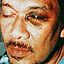anwar black eye