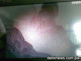 manohara odelia pinot scars on her body 100609 02