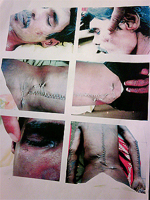 gnanaprakasam anthony injury autopsy