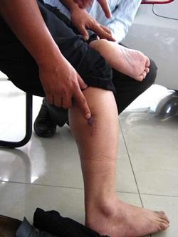 Yeow Leong Kang cab driver leg with bullet wound