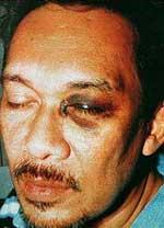 anwar ibrahim black eye small 080206