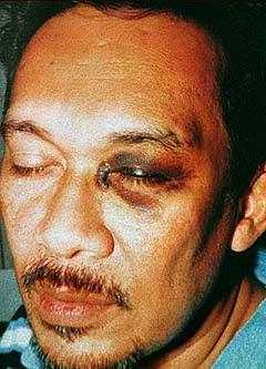 anwar ibrahim black eye 080206